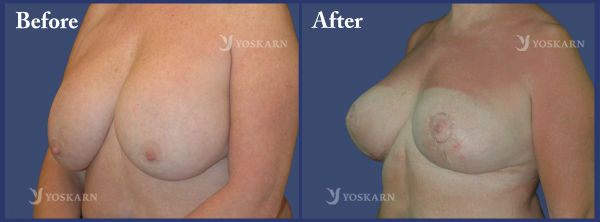 Breast Lift2.jpg (600×222)