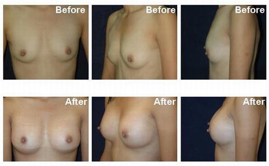 Breast-augmentation-1.jpg (500×310)