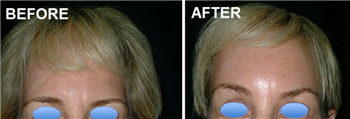 Forehead lift2.PNG (855×291)