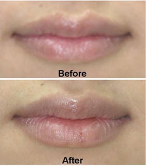Lips-Fillers.jpg (250×285)