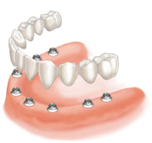 Full Arch Dental Implants