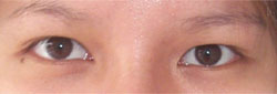 Upper Eyelid Surgery Before