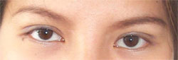 Upper Eyelid Surgery After