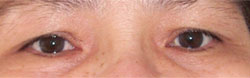 Upper Eyelid Surgery Before