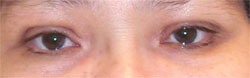 Upper Eyelid Surgery After