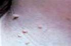 Skin tags