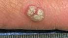 Wart