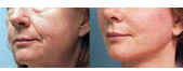 cheeklift with microfat grafting