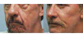 Cheek lift with microfat grafting