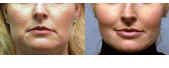 cheeklift with microfat grafting