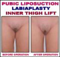 Pubic Liposuction