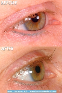 Before and 12 months After Eyelash Transplantation by Dr. Bauman