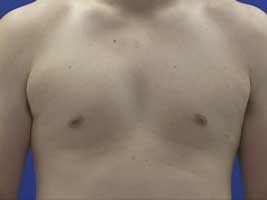Men with inverted nipples, male nipple inversion before surgery
