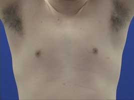 before inverted nipple surgery in men