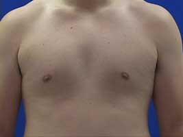 after surgery for inverted nipples or nipple inversion in men