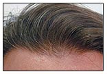 natural looking hair transplant photos