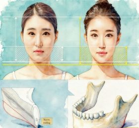 Jaw Reduction by Surgery Jaw Reduction by Surgery