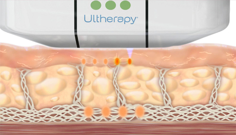 Ultherapy Thailand