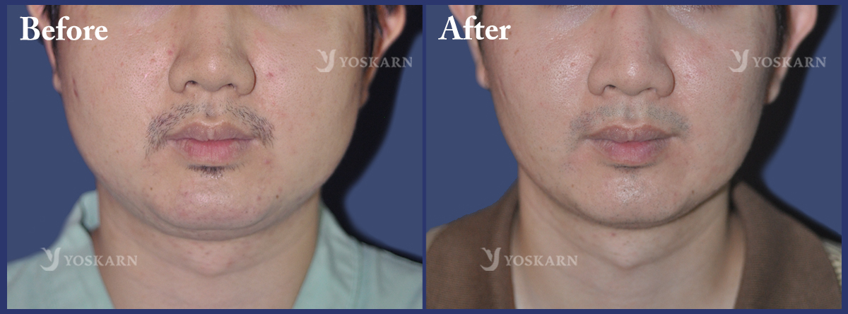 buccal fat removal Thailand