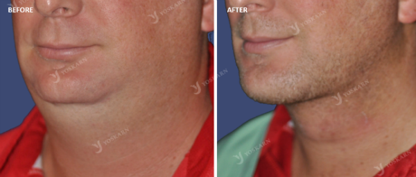 Chin Implant 3.png (600×255)