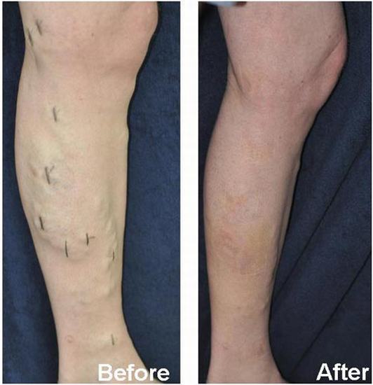 endovenous laser varicose vein surgery Thailand