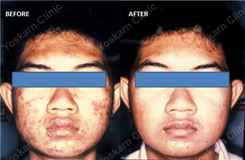 acne extraction Thailand