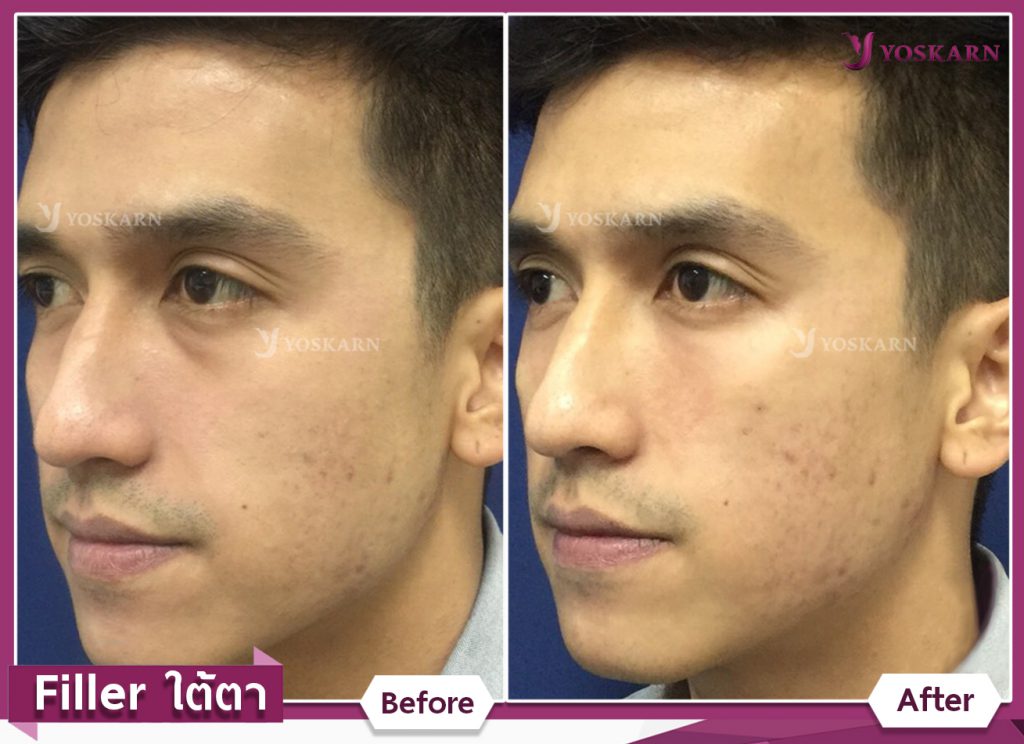 Fillers in Thailand