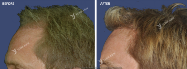 hair transplant4 (1).png (600×223)