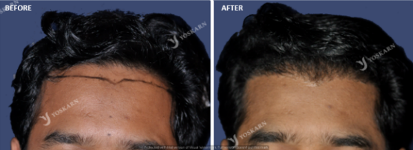 hairline lowering (1).png (600×218)