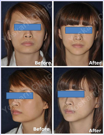 jaw reduction 3.png (836×1083)