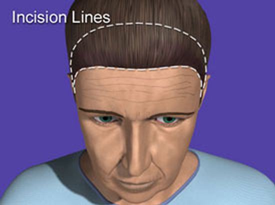 wrinkles_incision.jpg (275×205)