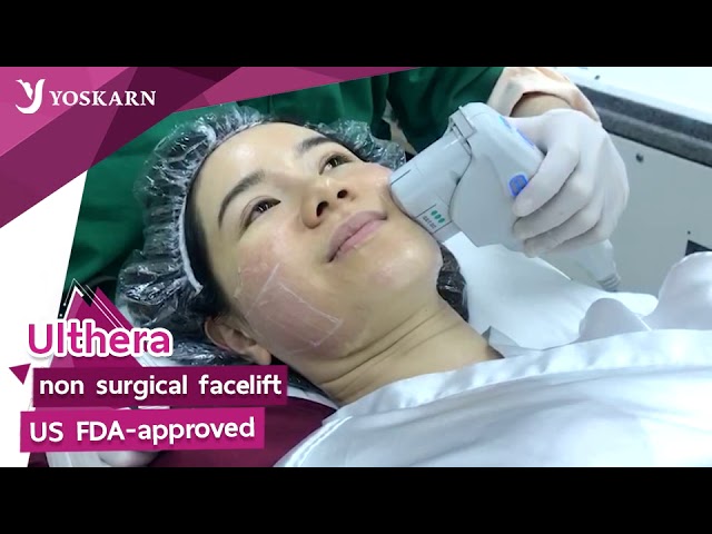 Non-Surgical facelift by Ulthera at Yoskarn Clinic